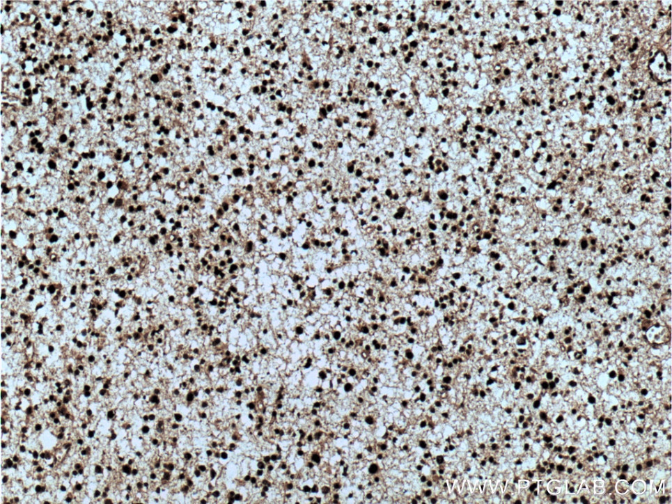 Immunohistochemistry (IHC) staining of human gliomas tissue using PES1 Polyclonal antibody (13553-1-AP)