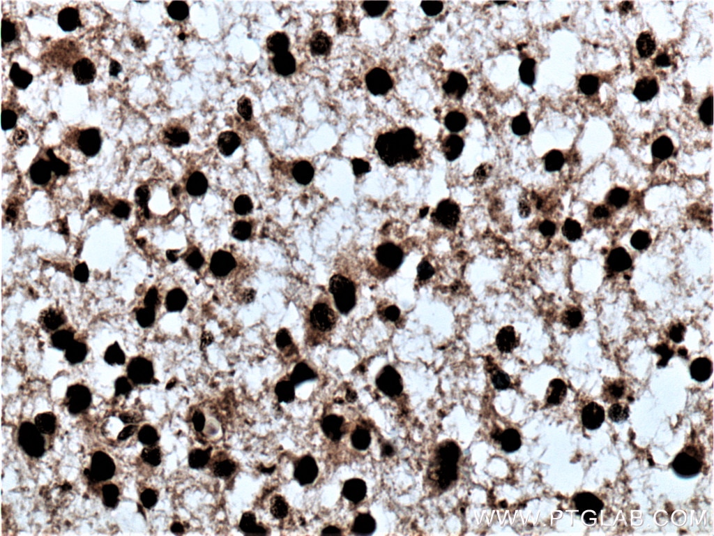 Immunohistochemistry (IHC) staining of human gliomas tissue using PES1 Polyclonal antibody (13553-1-AP)