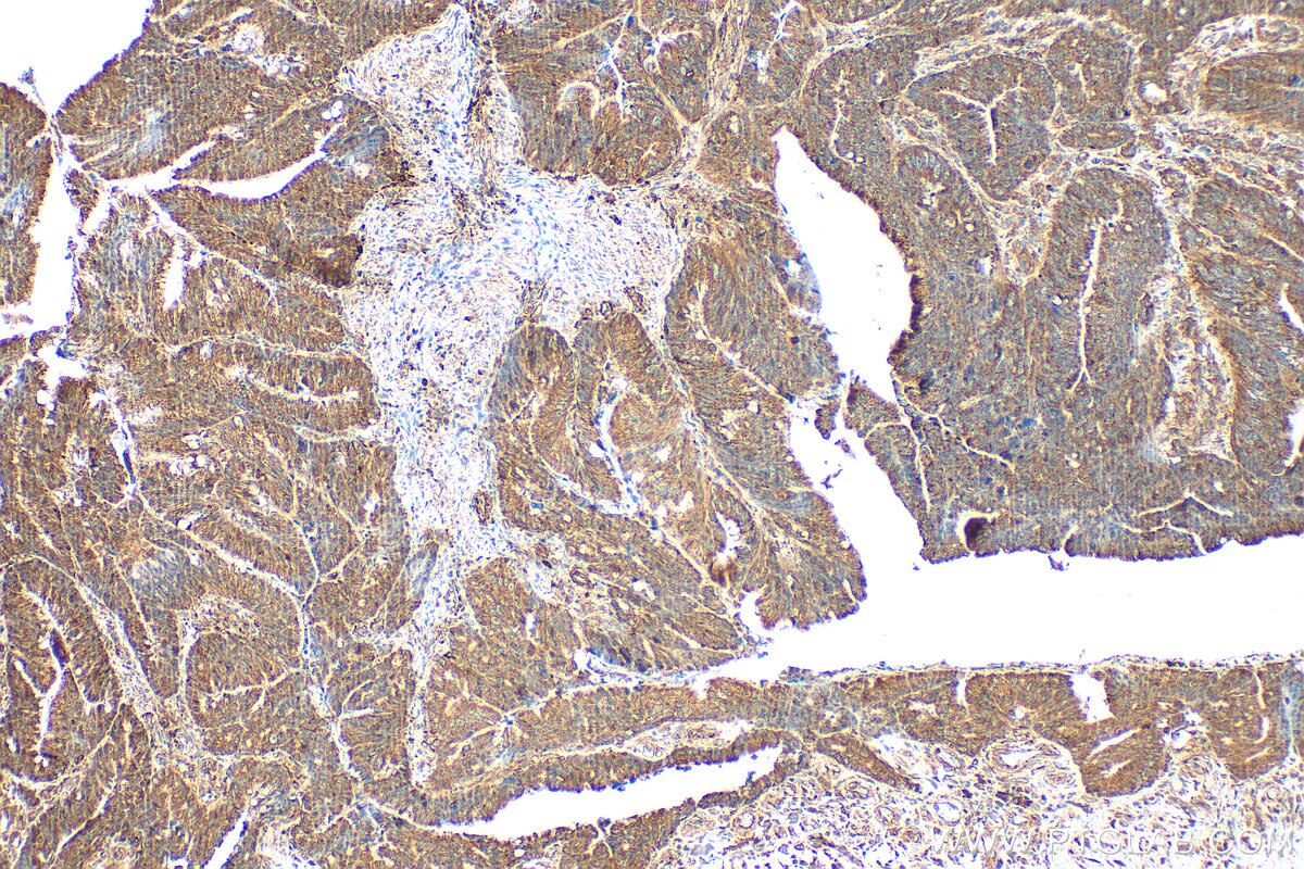 Immunohistochemistry (IHC) staining of human colon cancer tissue using PET100 Polyclonal antibody (31322-1-AP)