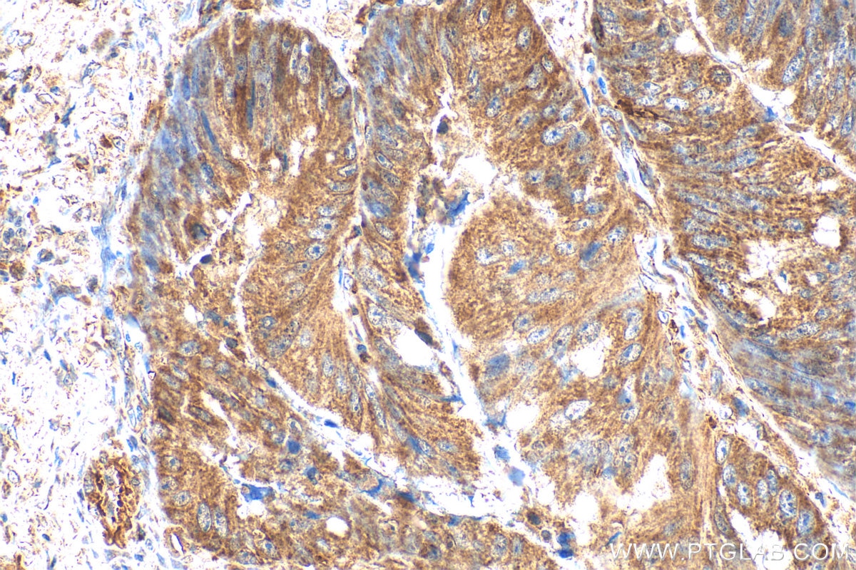 Immunohistochemistry (IHC) staining of human colon cancer tissue using PET100 Polyclonal antibody (31322-1-AP)