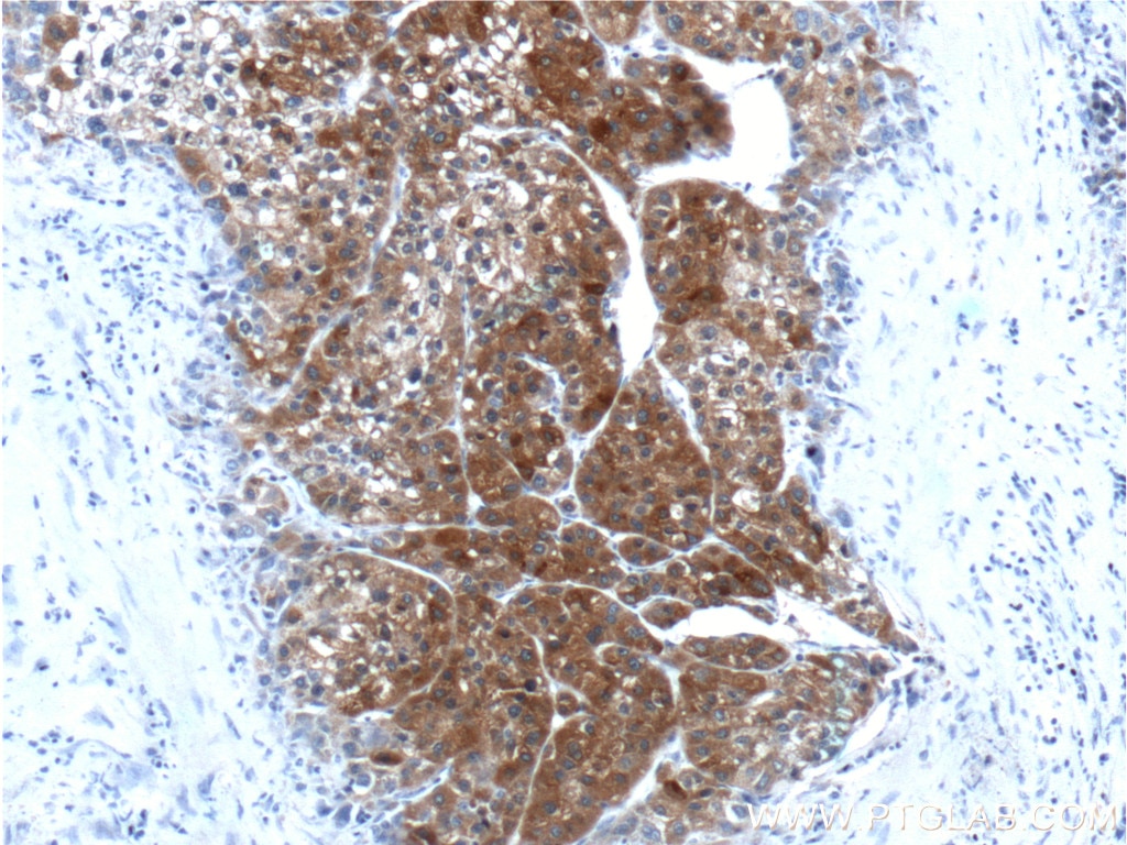 Immunohistochemistry (IHC) staining of human liver cancer tissue using PEX1 Polyclonal antibody (13669-1-AP)