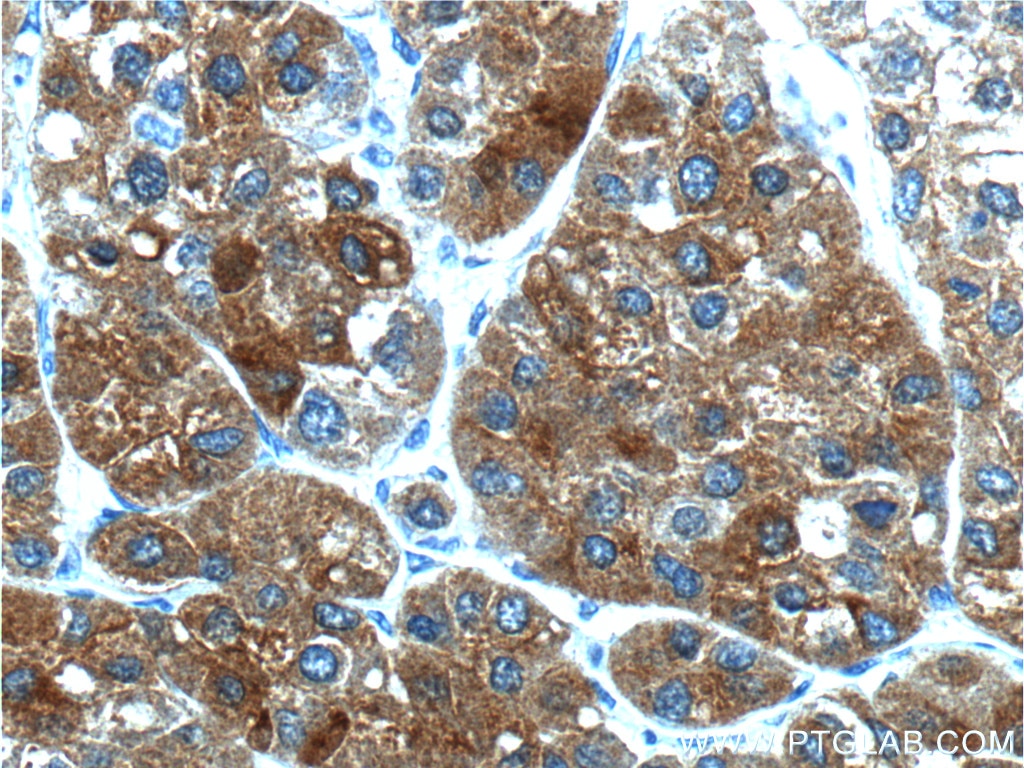 Immunohistochemistry (IHC) staining of human liver cancer tissue using PEX1 Polyclonal antibody (13669-1-AP)
