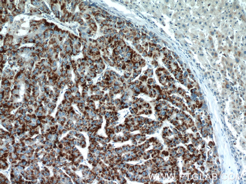 Immunohistochemistry (IHC) staining of human liver cancer tissue using PEX14 Polyclonal antibody (10594-1-AP)