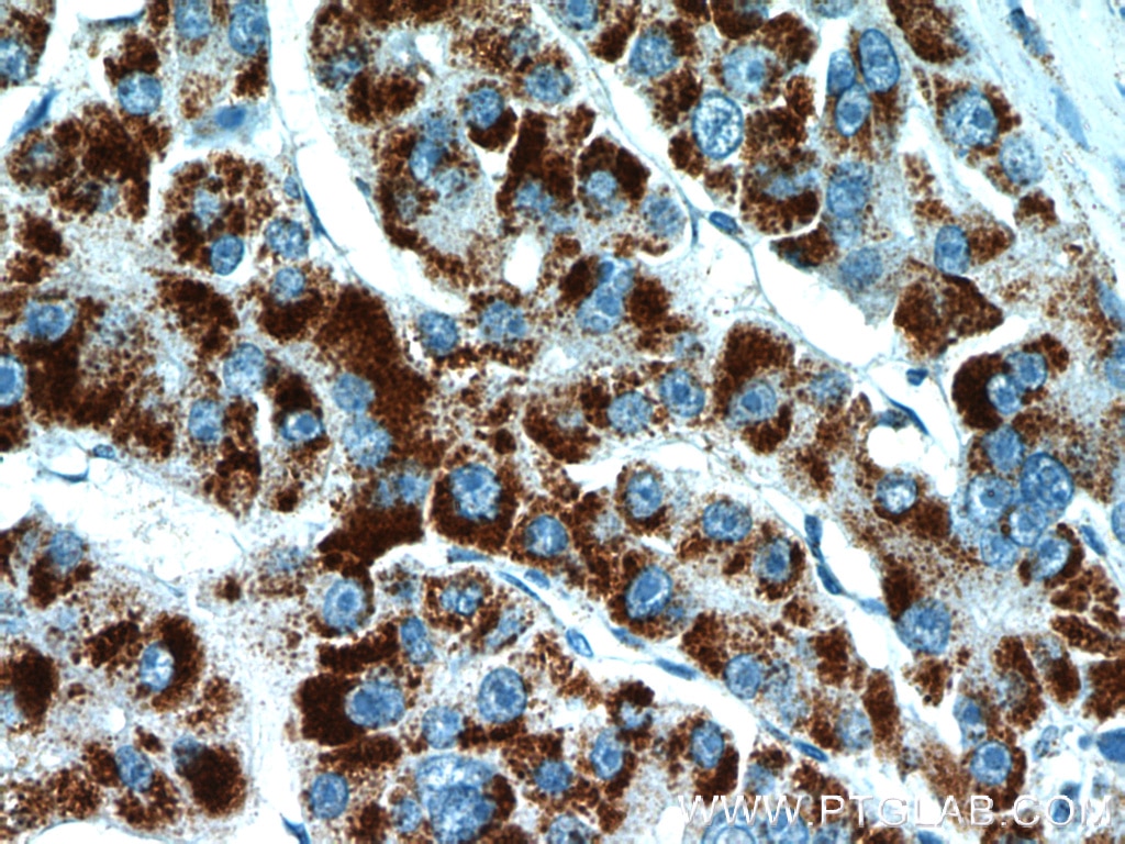 IHC staining of human liver cancer using 10594-1-AP