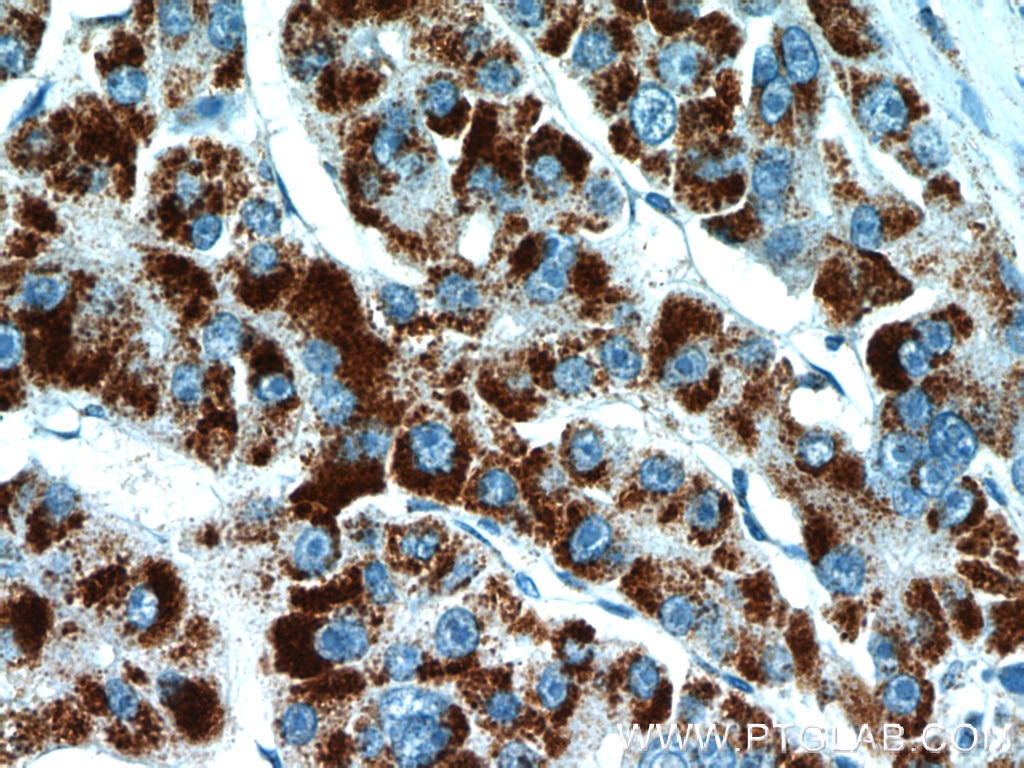 Immunohistochemistry (IHC) staining of human liver cancer tissue using PEX14 Polyclonal antibody (10594-1-AP)