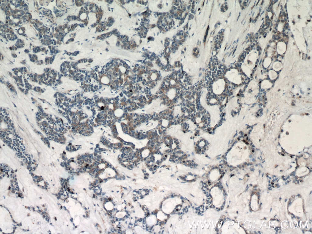 IHC staining of human cervical cancer using 10594-1-AP