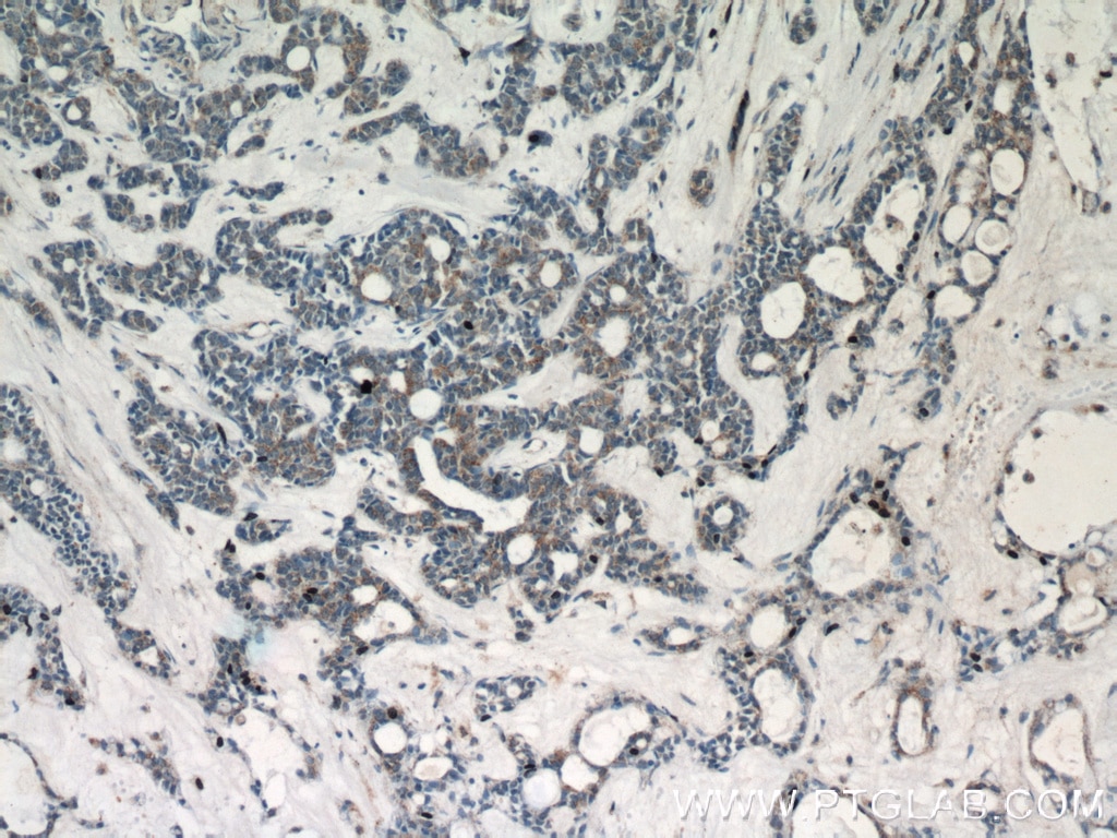 Immunohistochemistry (IHC) staining of human cervical cancer tissue using PEX14 Polyclonal antibody (10594-1-AP)