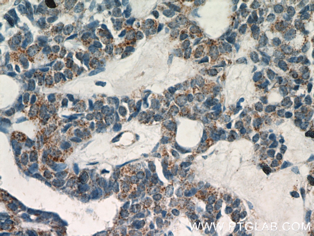 Immunohistochemistry (IHC) staining of human cervical cancer tissue using PEX14 Polyclonal antibody (10594-1-AP)