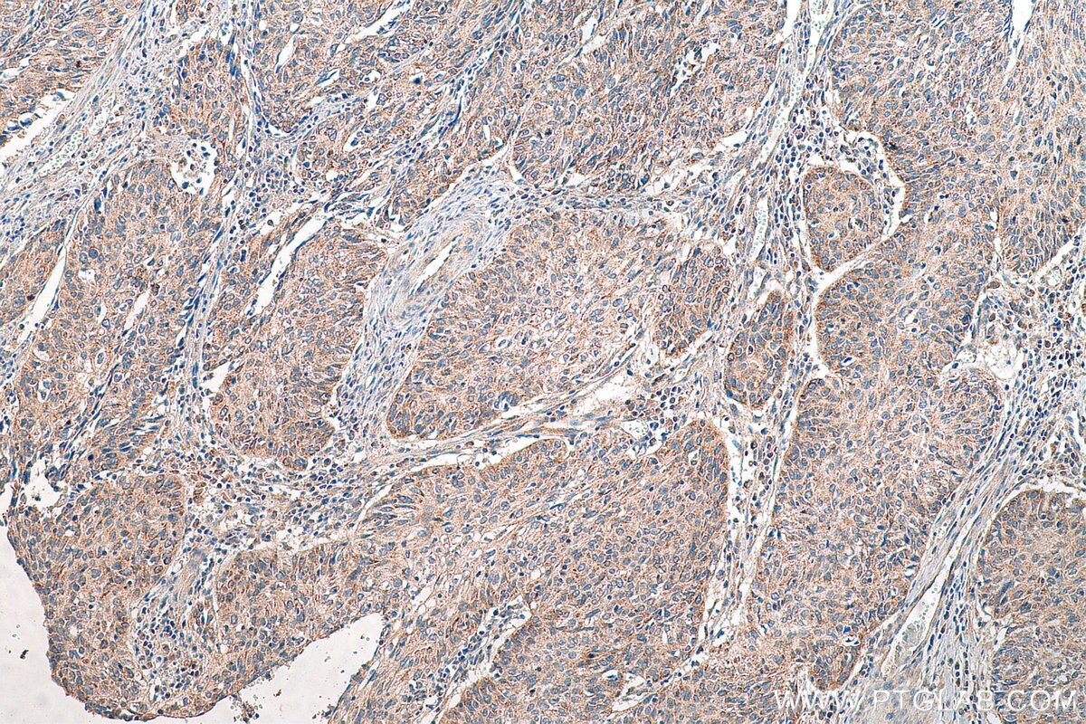 Immunohistochemistry (IHC) staining of human cervical cancer tissue using PEX14 Recombinant antibody (80234-1-RR)