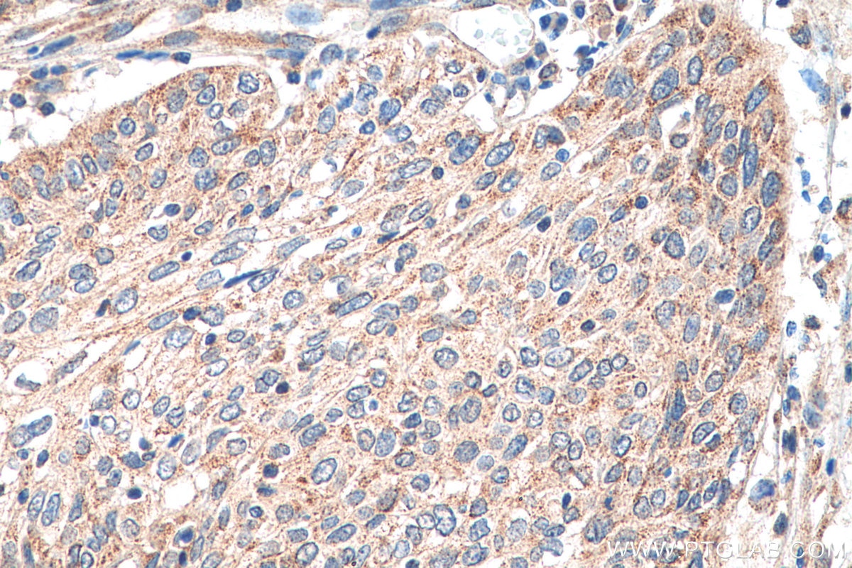 Immunohistochemistry (IHC) staining of human cervical cancer tissue using PEX14 Recombinant antibody (80234-1-RR)