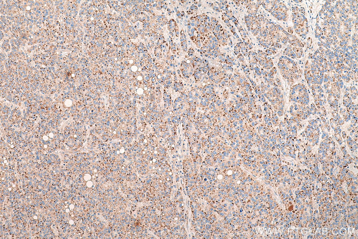 IHC staining of human liver cancer using 80234-1-RR
