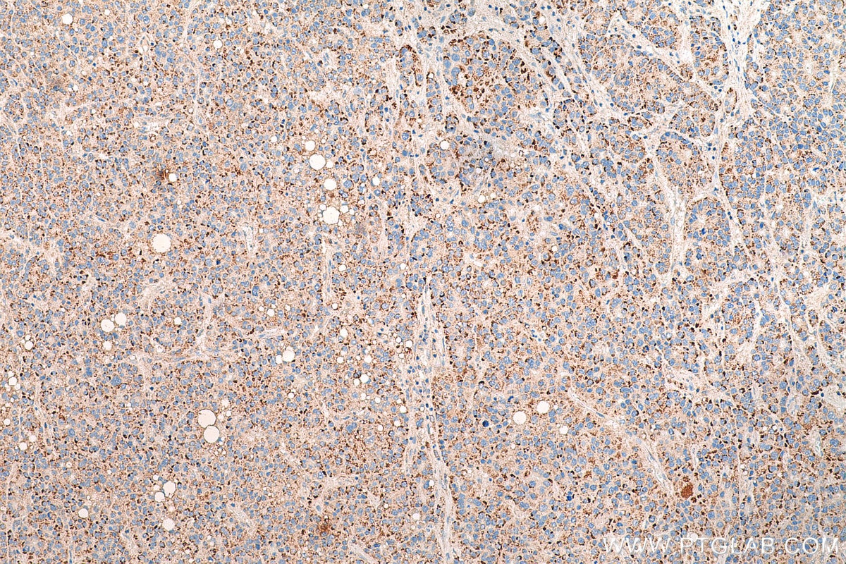 Immunohistochemistry (IHC) staining of human liver cancer tissue using PEX14 Recombinant antibody (80234-1-RR)