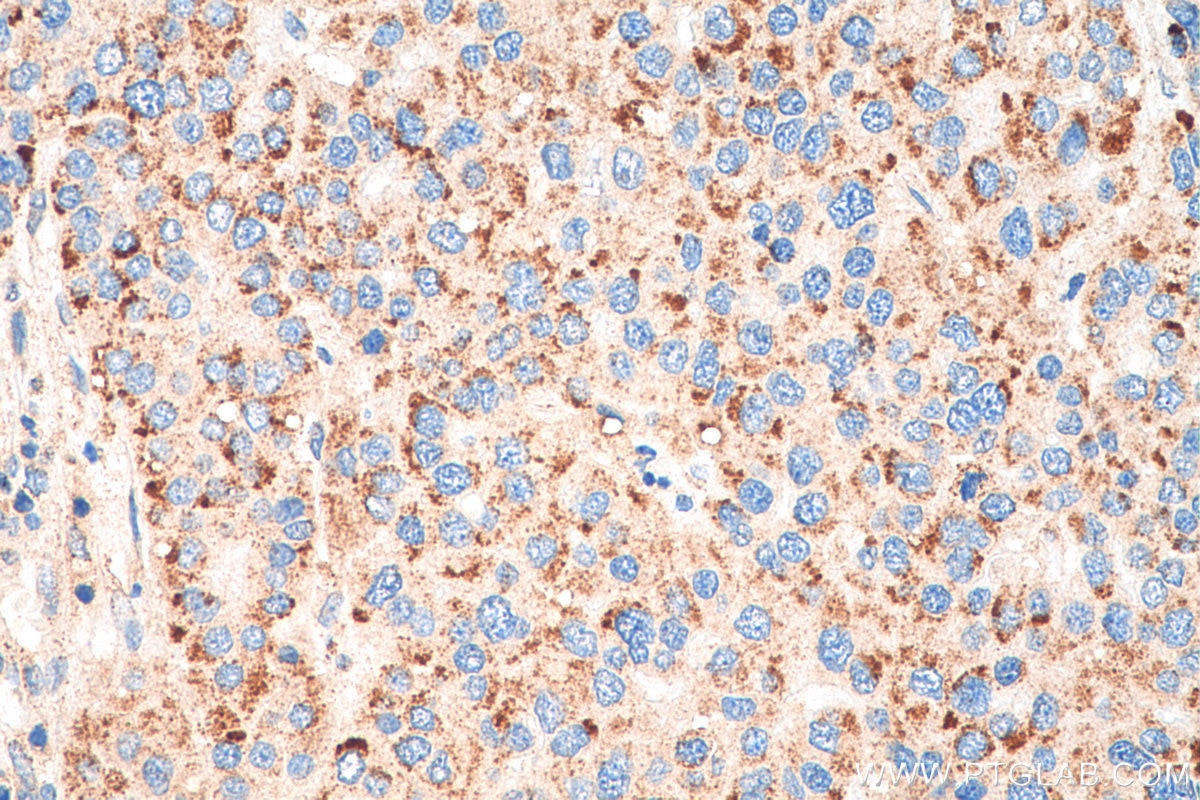Immunohistochemistry (IHC) staining of human liver cancer tissue using PEX14 Recombinant antibody (80234-1-RR)