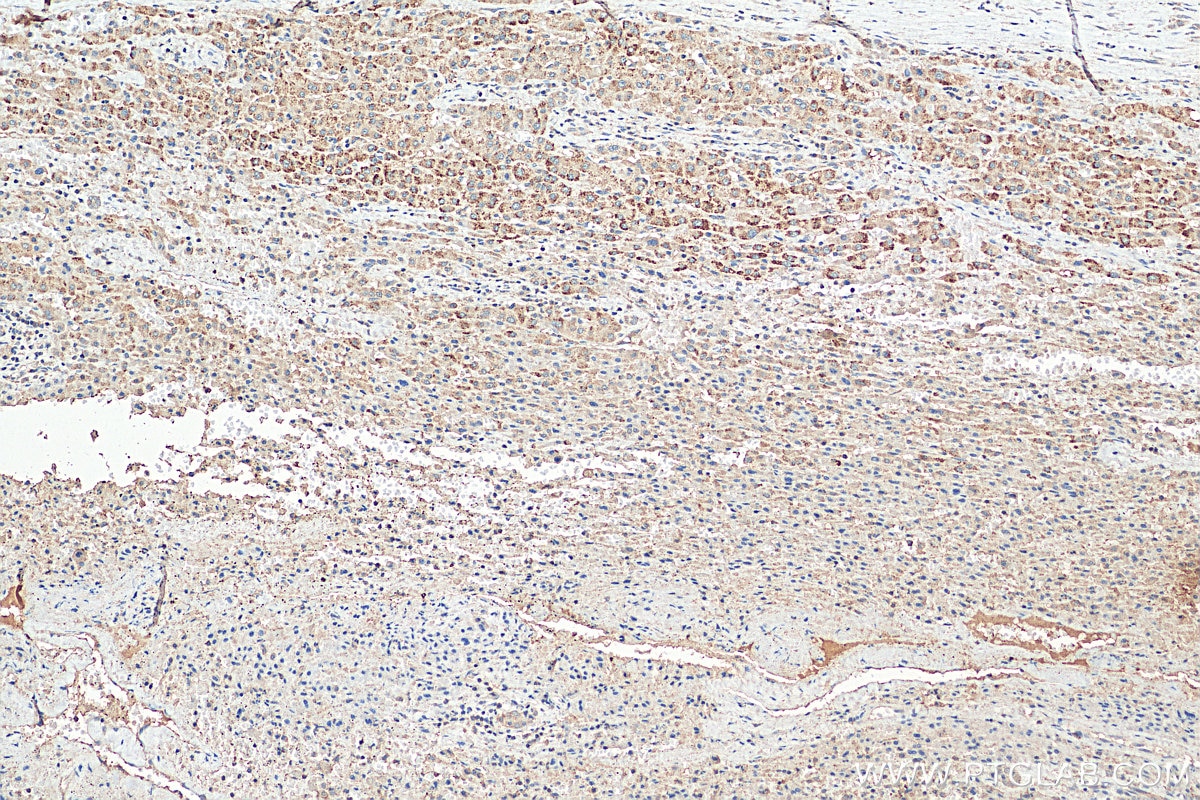 Immunohistochemistry (IHC) staining of human liver cancer tissue using PEX14 (human specific) Recombinant antibody (80196-1-RR)