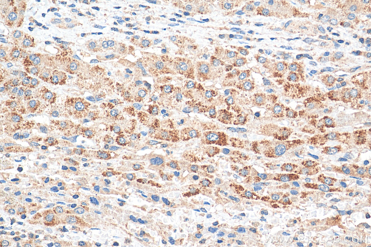 Immunohistochemistry (IHC) staining of human liver cancer tissue using PEX14 (human specific) Recombinant antibody (80196-1-RR)
