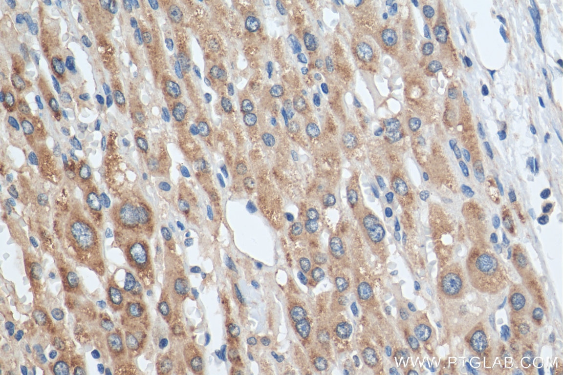 Immunohistochemistry (IHC) staining of human liver cancer tissue using PEX19 Polyclonal antibody (14713-1-AP)