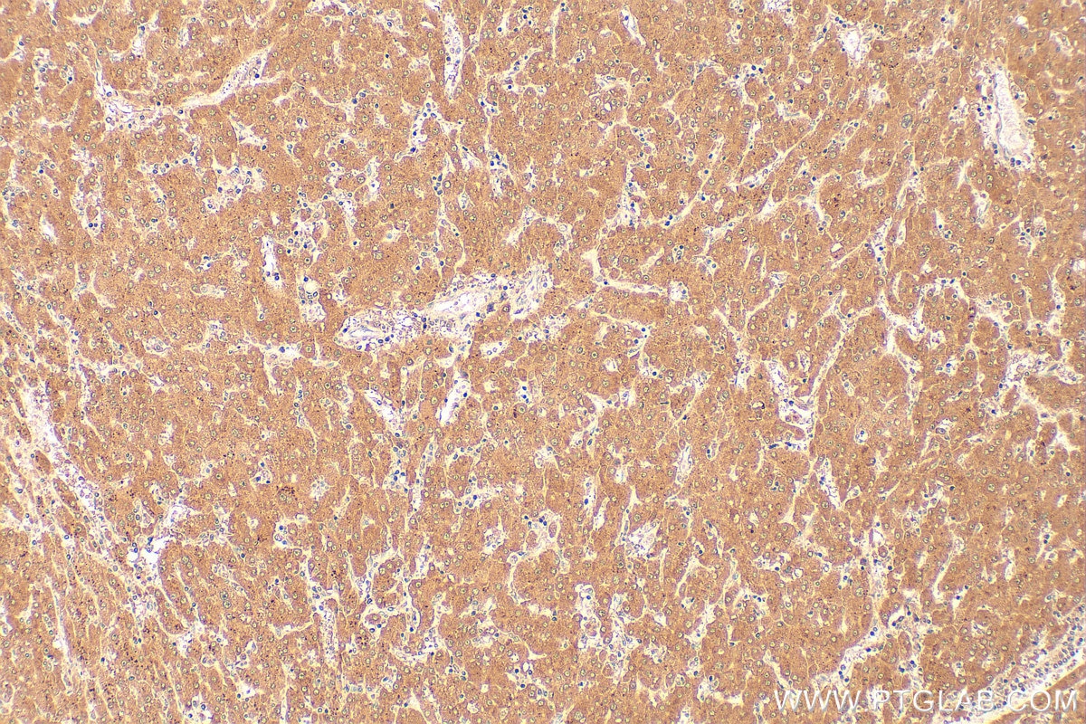 Immunohistochemistry (IHC) staining of human liver cancer tissue using PEX19 Monoclonal antibody (68555-1-Ig)