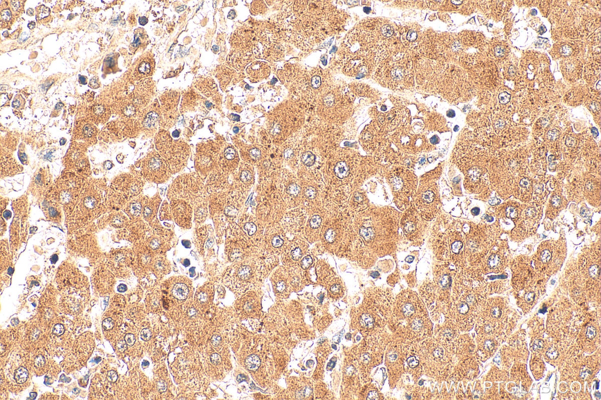 Immunohistochemistry (IHC) staining of human liver cancer tissue using PEX19 Monoclonal antibody (68555-1-Ig)