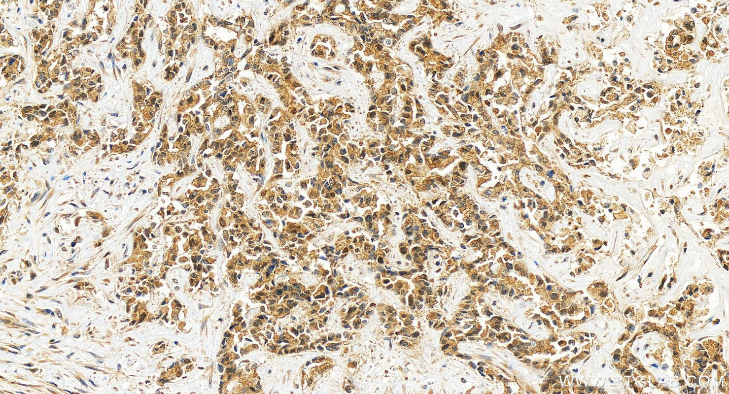Immunohistochemistry (IHC) staining of human intrahepatic cholangiocarcinoma tissue using PFAS Polyclonal antibody (24716-1-AP)