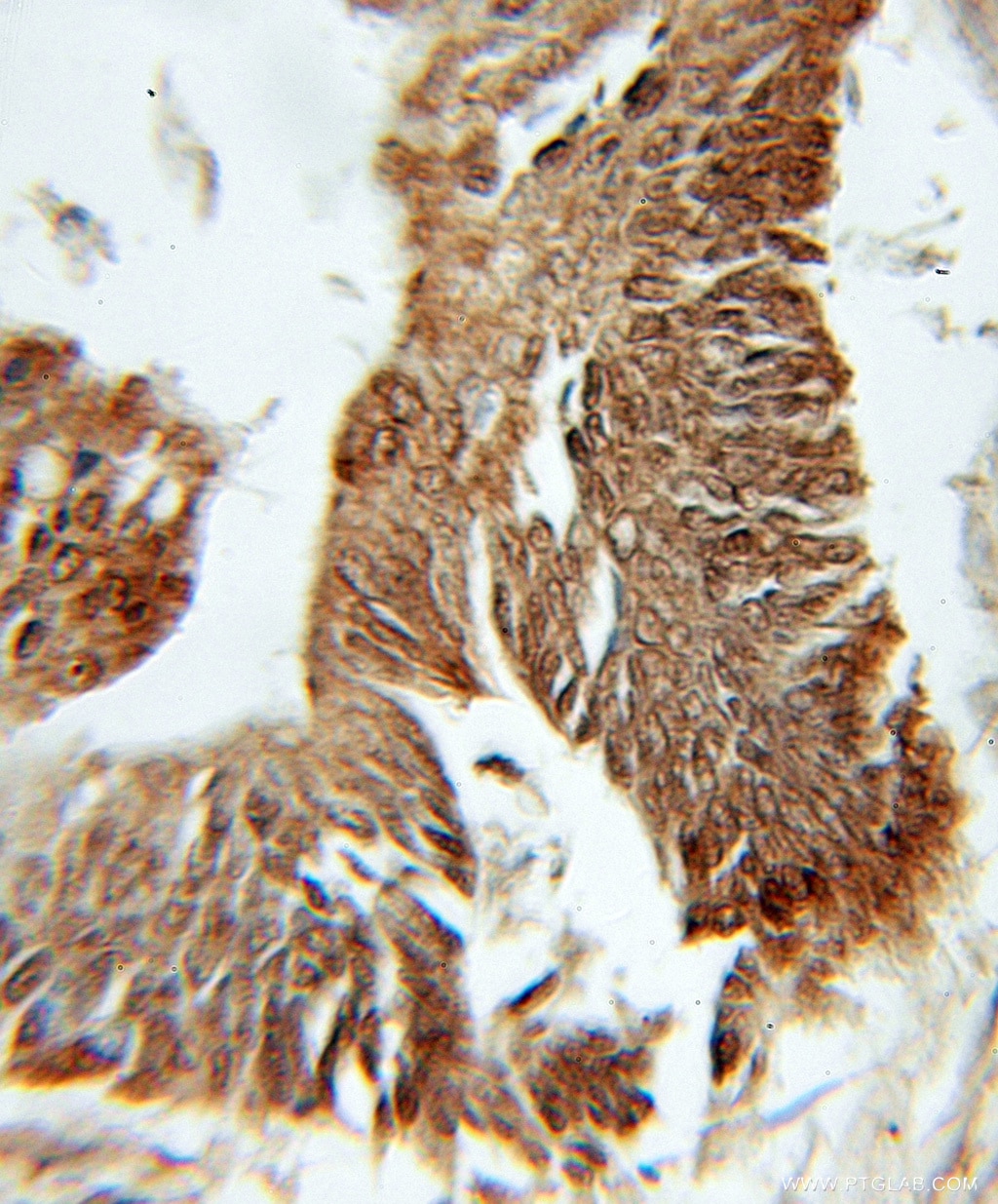 Immunohistochemistry (IHC) staining of human colon cancer tissue using PFDN1 Polyclonal antibody (11033-2-AP)