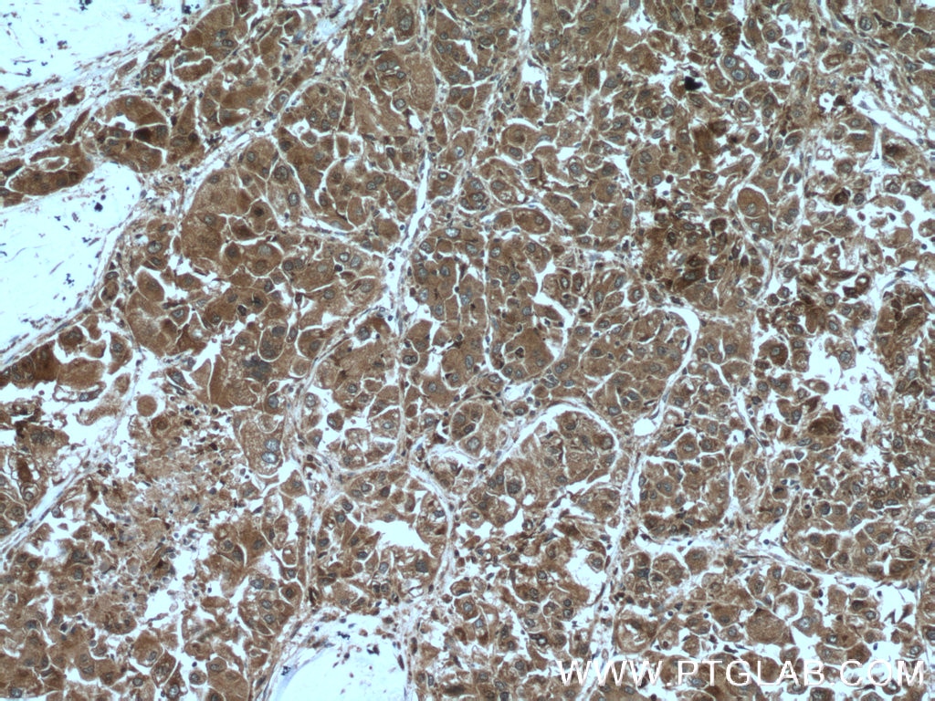 IHC staining of human liver cancer using 13053-1-AP