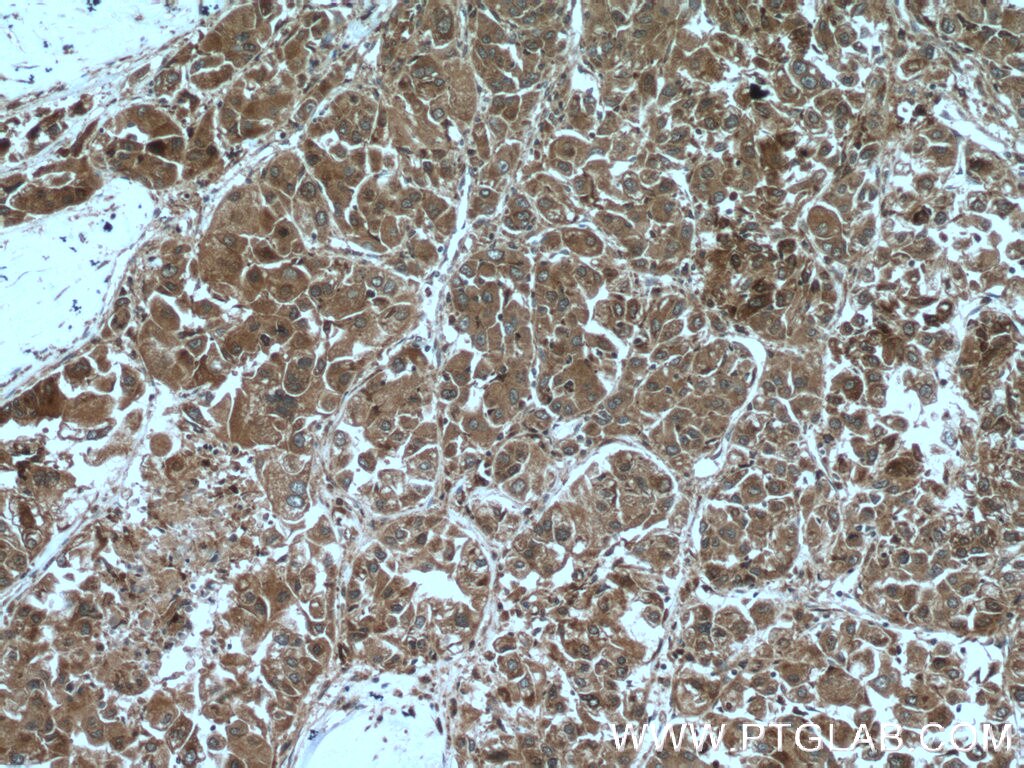 Immunohistochemistry (IHC) staining of human liver cancer tissue using PFDN2 Polyclonal antibody (13053-1-AP)