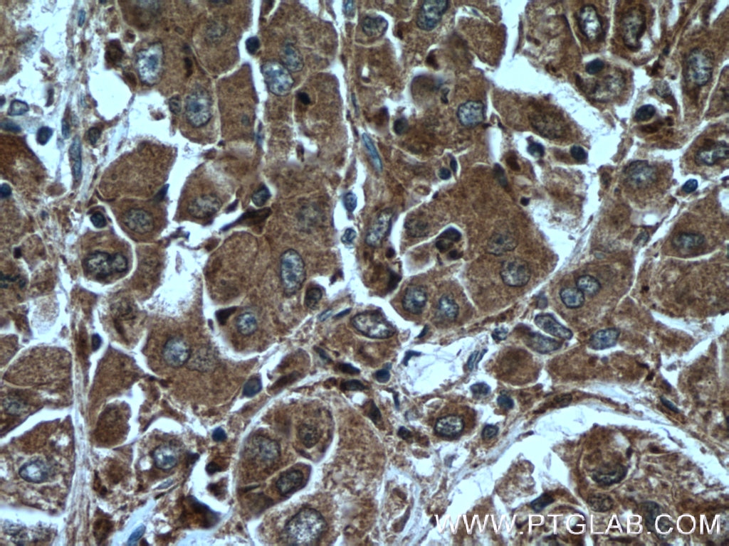Immunohistochemistry (IHC) staining of human liver cancer tissue using PFDN2 Polyclonal antibody (13053-1-AP)
