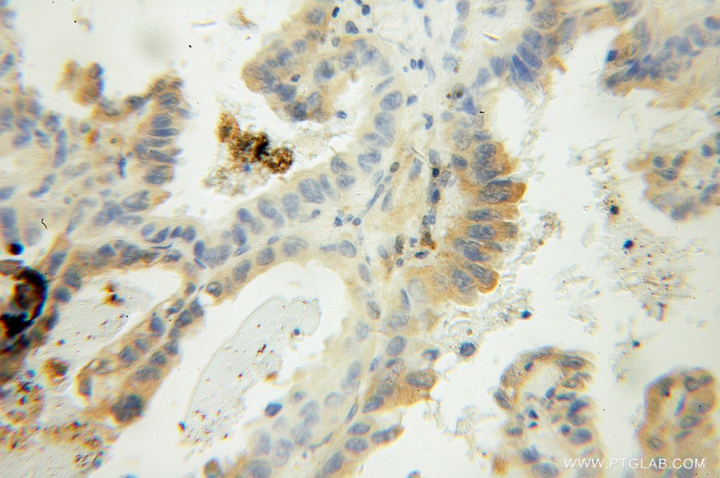 Immunohistochemistry (IHC) staining of human lung cancer tissue using PFDN2 Polyclonal antibody (13053-1-AP)
