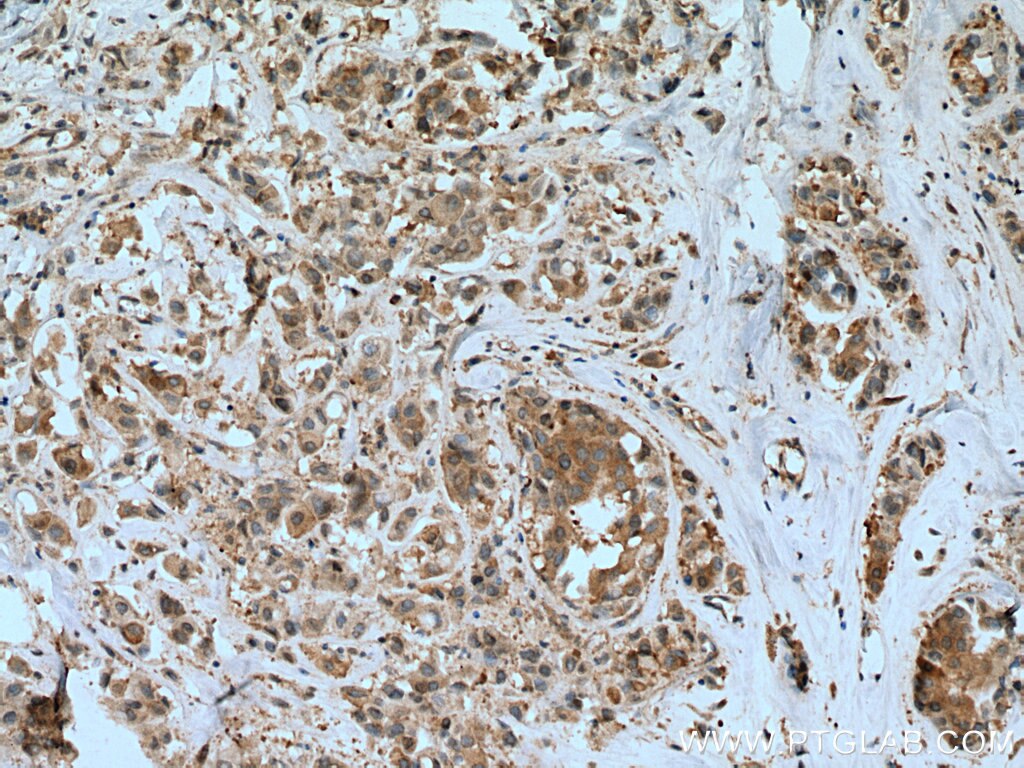 Immunohistochemistry (IHC) staining of human breast cancer tissue using PFDN4 Polyclonal antibody (16045-1-AP)