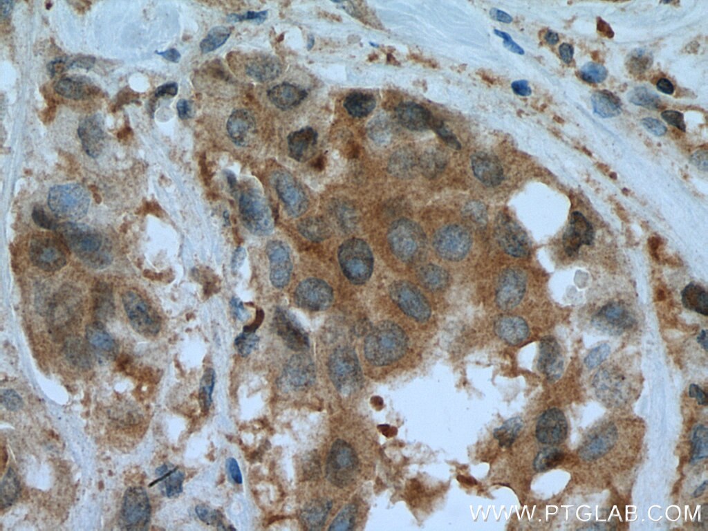 Immunohistochemistry (IHC) staining of human breast cancer tissue using PFDN4 Polyclonal antibody (16045-1-AP)