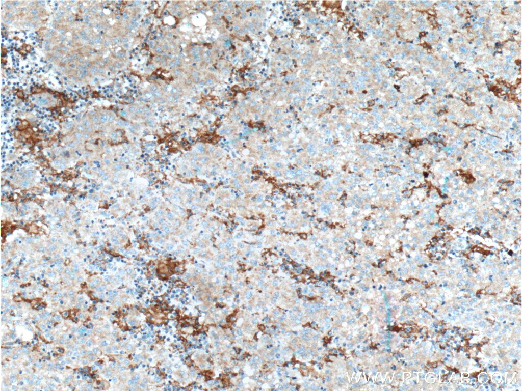 Immunohistochemistry (IHC) staining of human liver cancer tissue using PFKFB1 Polyclonal antibody (21718-1-AP)