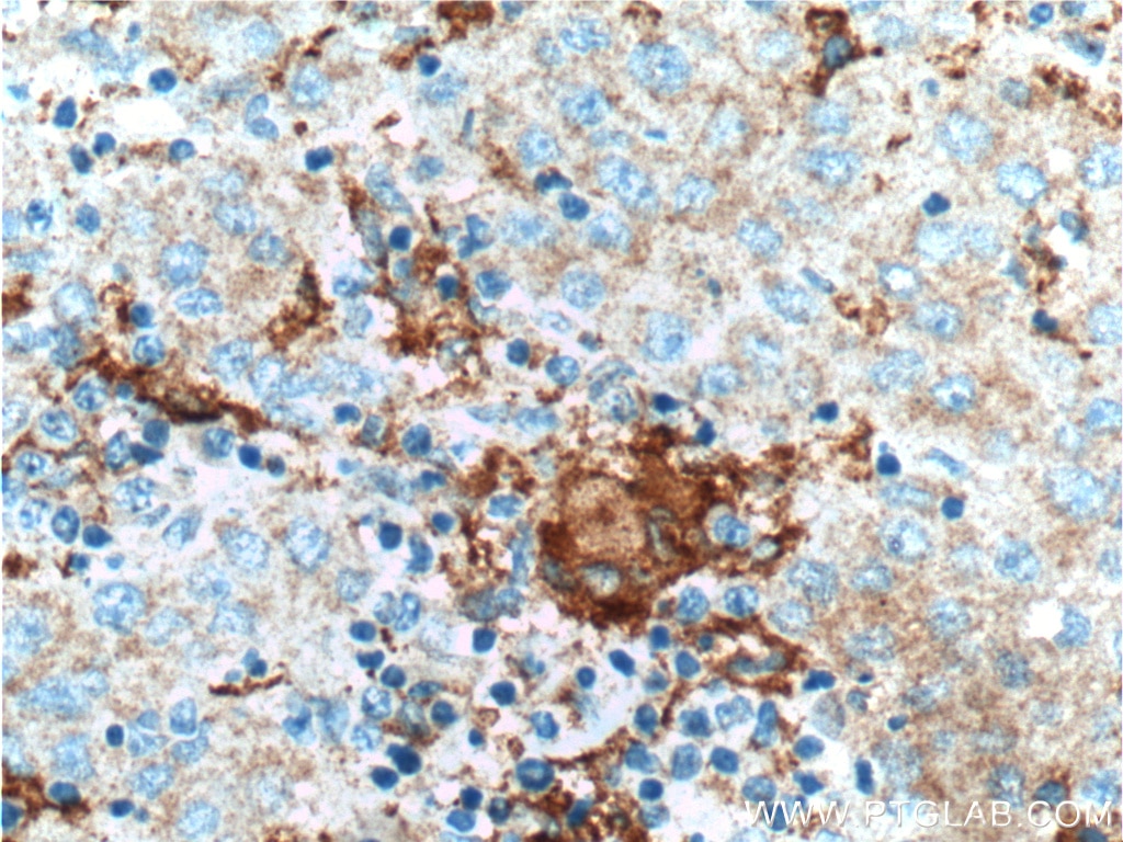 Immunohistochemistry (IHC) staining of human liver cancer tissue using PFKFB1 Polyclonal antibody (21718-1-AP)
