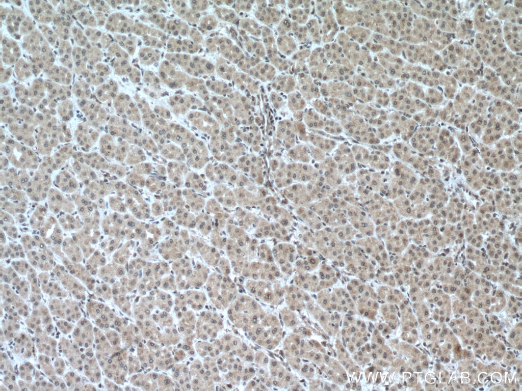 Immunohistochemistry (IHC) staining of human liver cancer tissue using PFKFB3 Polyclonal antibody (13763-1-AP)