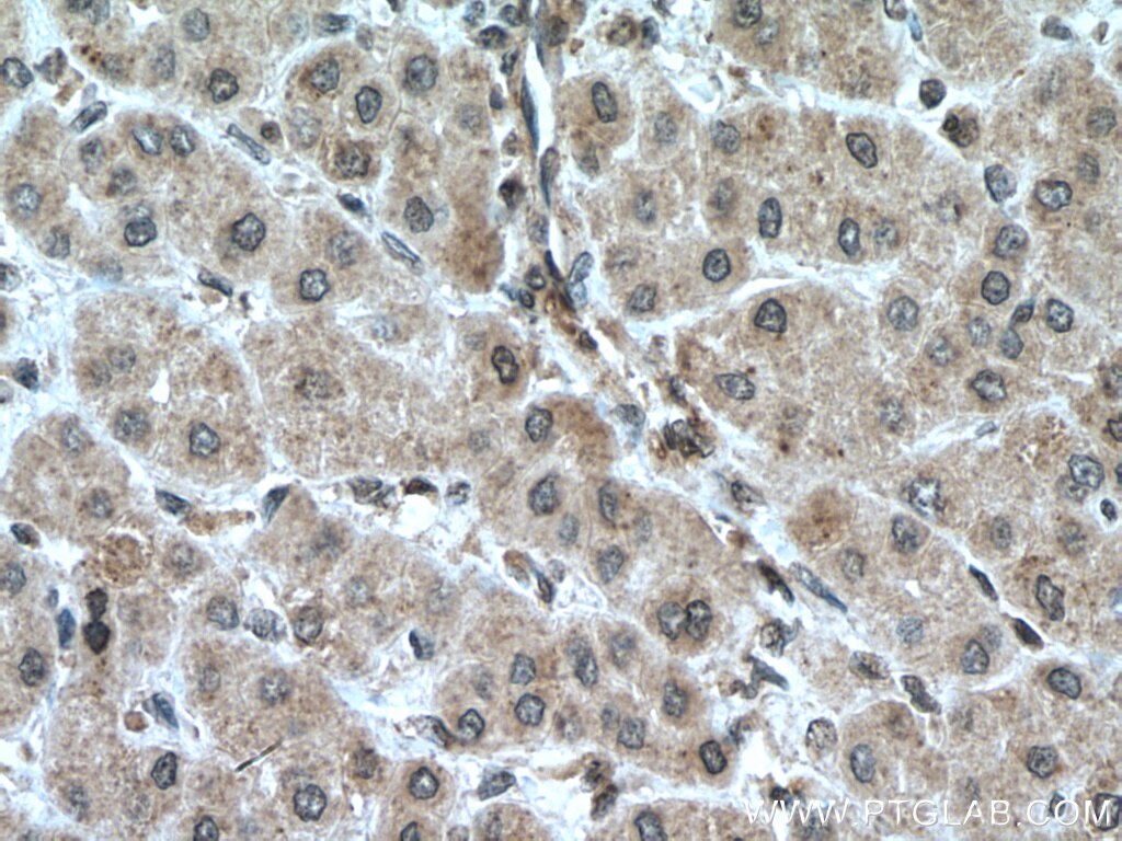 Immunohistochemistry (IHC) staining of human liver cancer tissue using PFKFB3 Polyclonal antibody (13763-1-AP)