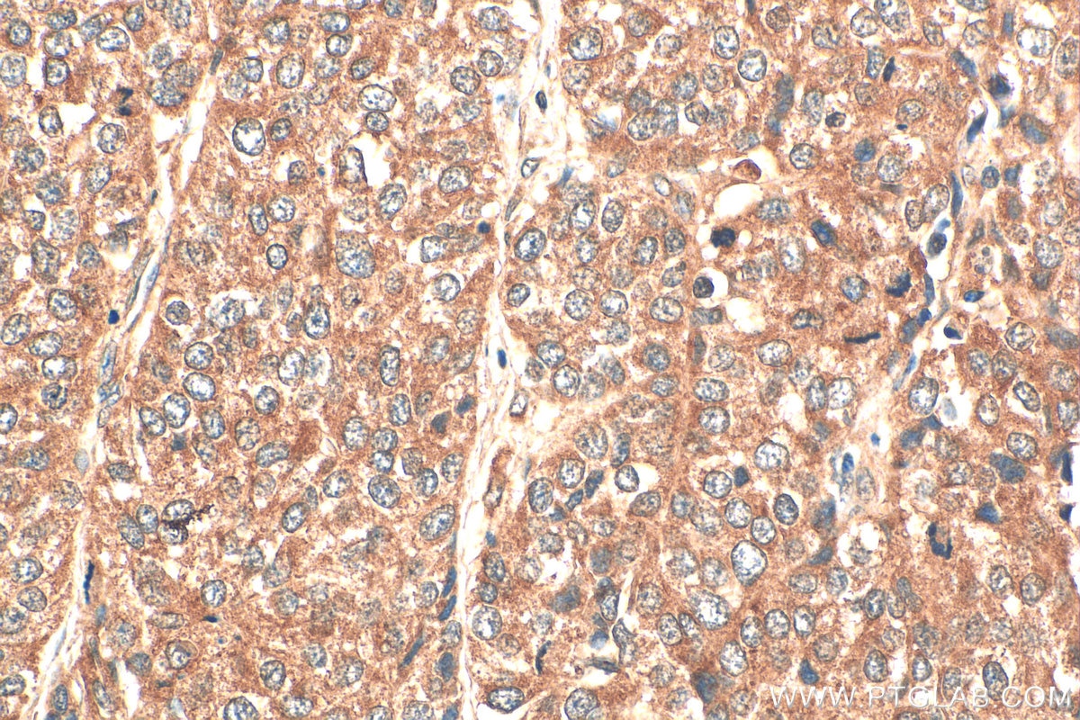 Immunohistochemistry (IHC) staining of human stomach cancer tissue using PFKFB3 Polyclonal antibody (13763-1-AP)