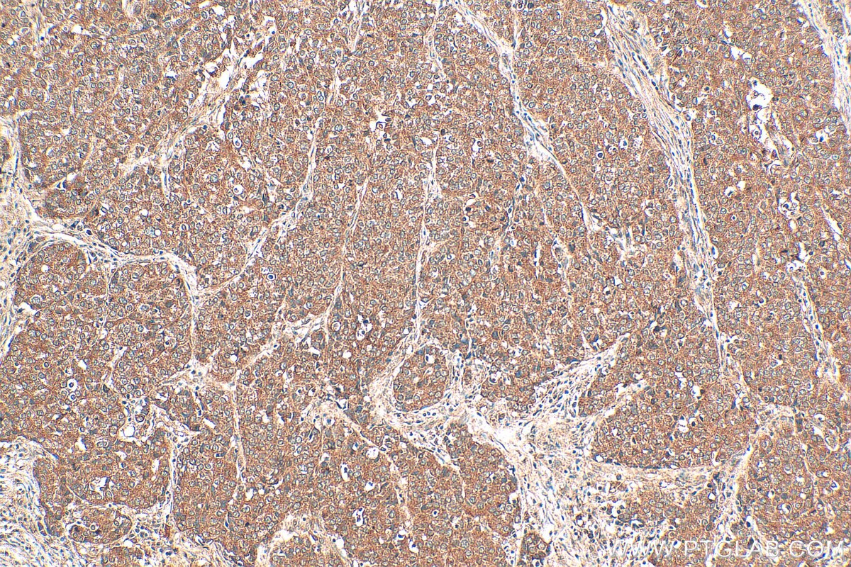 Immunohistochemistry (IHC) staining of human stomach cancer tissue using PFKFB3 Polyclonal antibody (13763-1-AP)