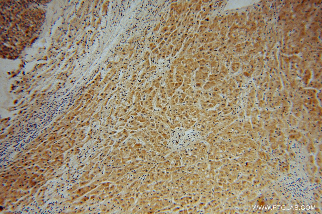 Immunohistochemistry (IHC) staining of human liver cancer tissue using PFKL Polyclonal antibody (15652-1-AP)