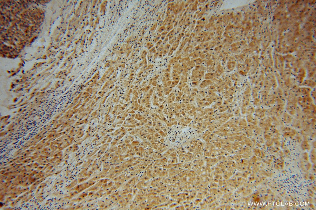 IHC staining of human liver cancer using 15652-1-AP