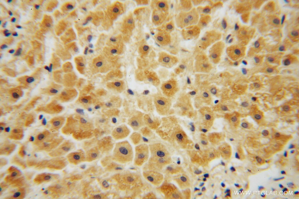 Immunohistochemistry (IHC) staining of human liver cancer tissue using PFKL Polyclonal antibody (15652-1-AP)