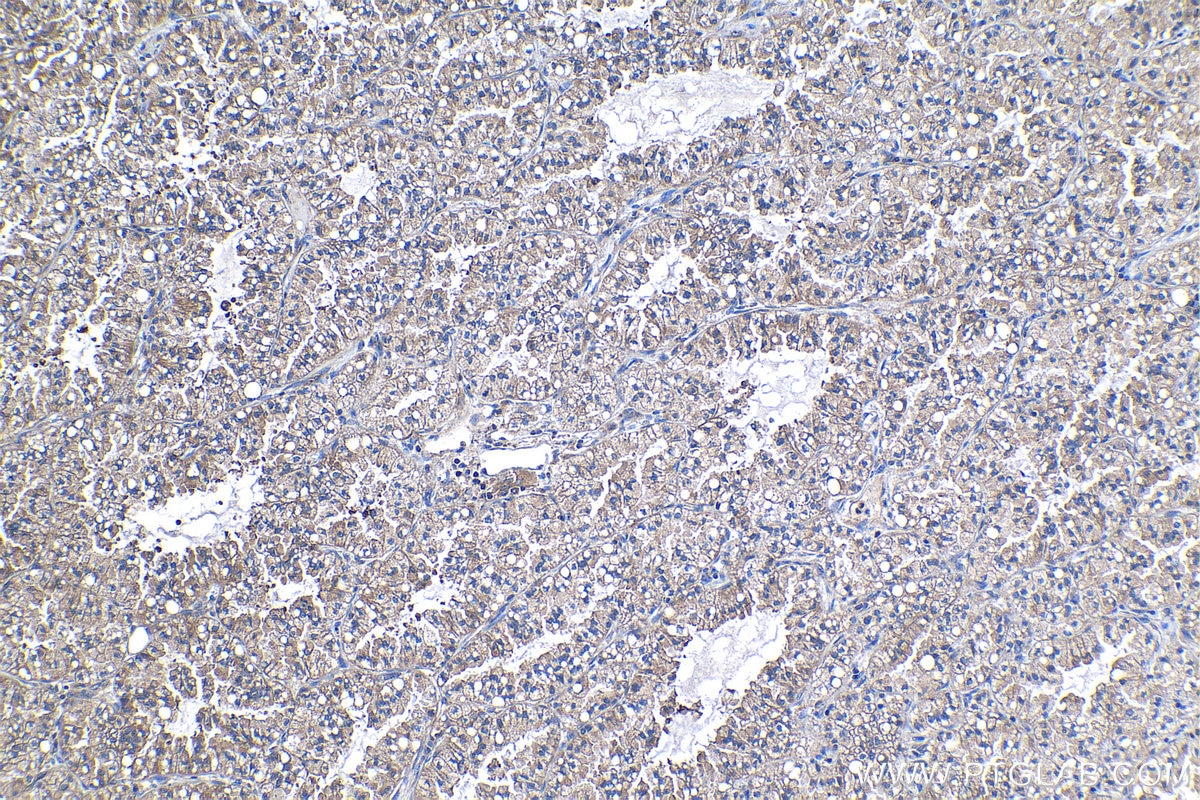 IHC staining of human lung cancer using 68385-1-Ig