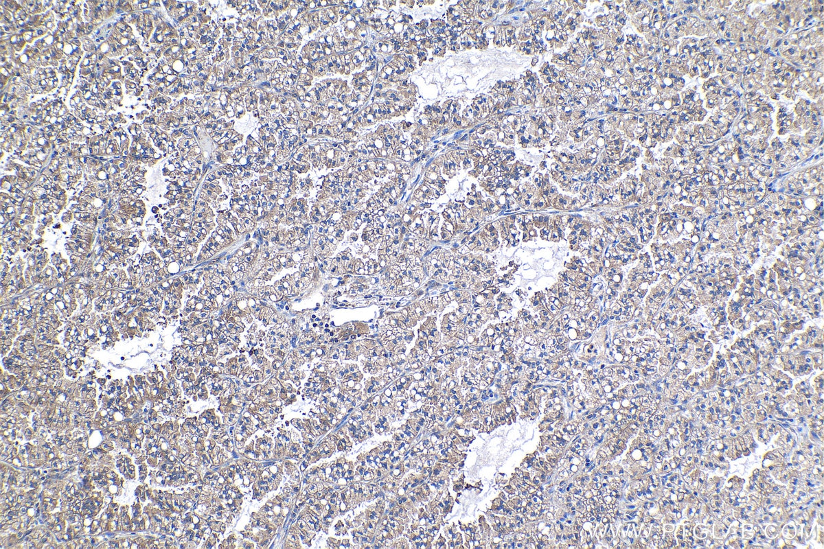 Immunohistochemistry (IHC) staining of human lung cancer tissue using PFKL Monoclonal antibody (68385-1-Ig)