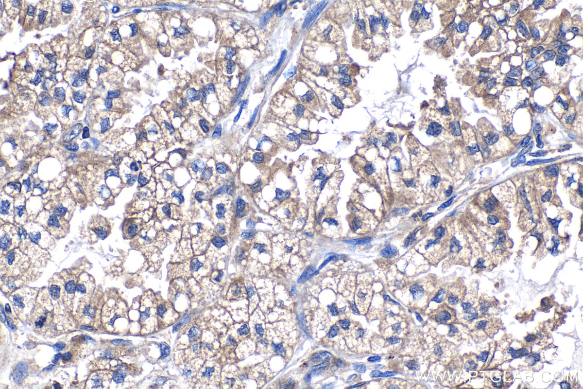 Immunohistochemistry (IHC) staining of human lung cancer tissue using PFKL Monoclonal antibody (68385-1-Ig)