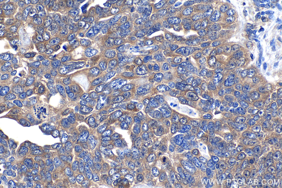 Immunohistochemistry (IHC) staining of human ovary tumor tissue using PFKL Monoclonal antibody (68385-1-Ig)