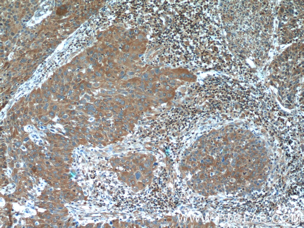 IHC staining of human lung cancer using 13389-1-AP