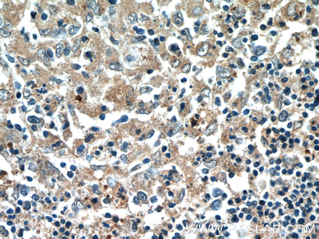 Immunohistochemistry (IHC) staining of human spleen tissue using PFKP Polyclonal antibody (13389-1-AP)