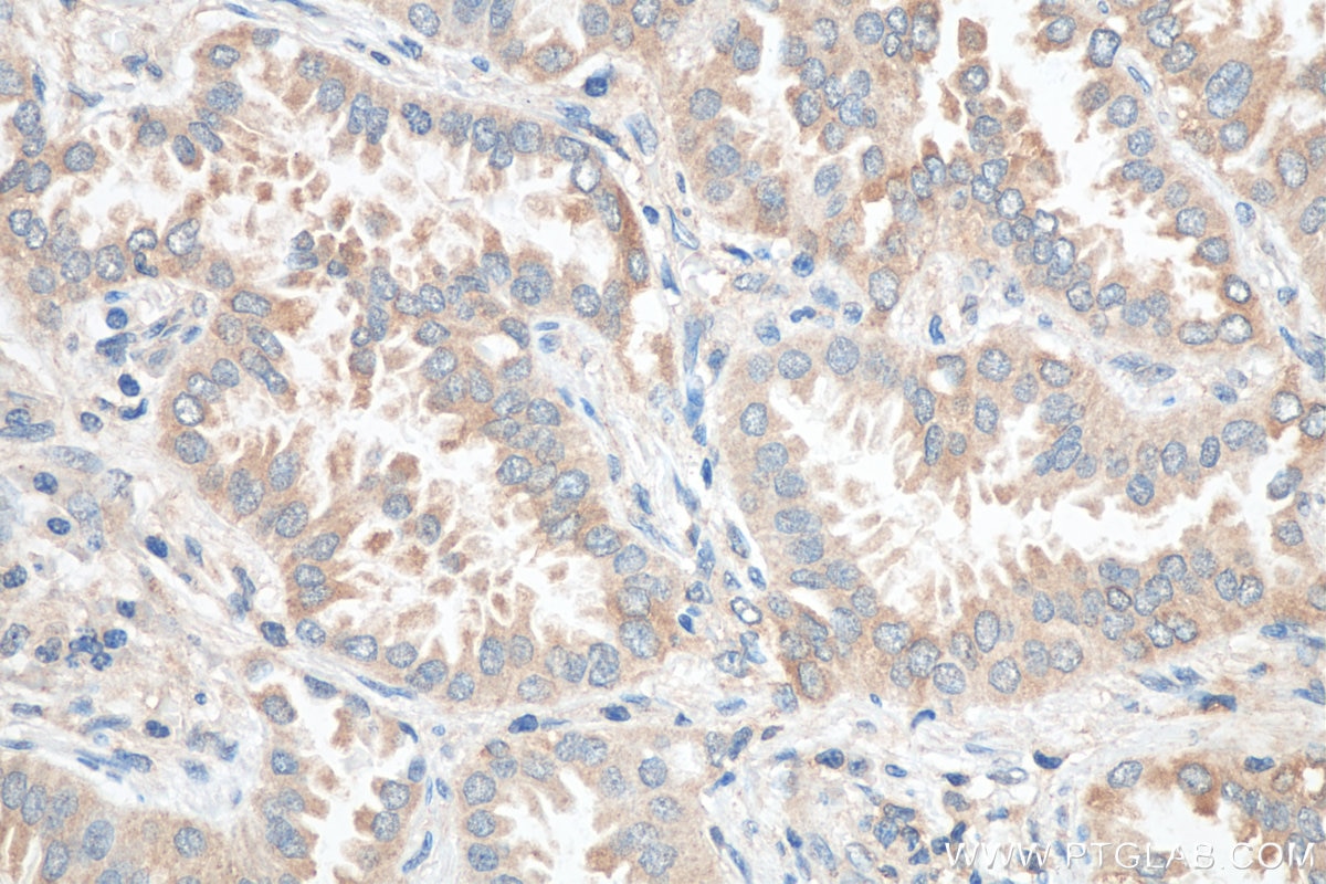 Immunohistochemistry (IHC) staining of human lung cancer tissue using PFKP Polyclonal antibody (13389-1-AP)