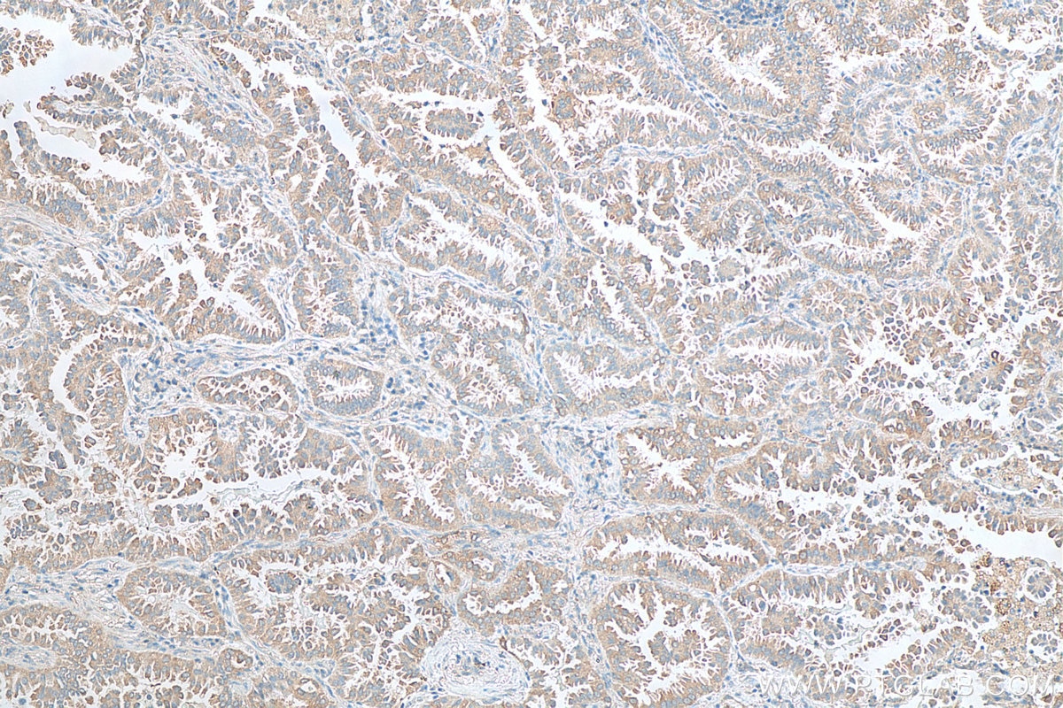 Immunohistochemistry (IHC) staining of human lung cancer tissue using PFKP Polyclonal antibody (13389-1-AP)