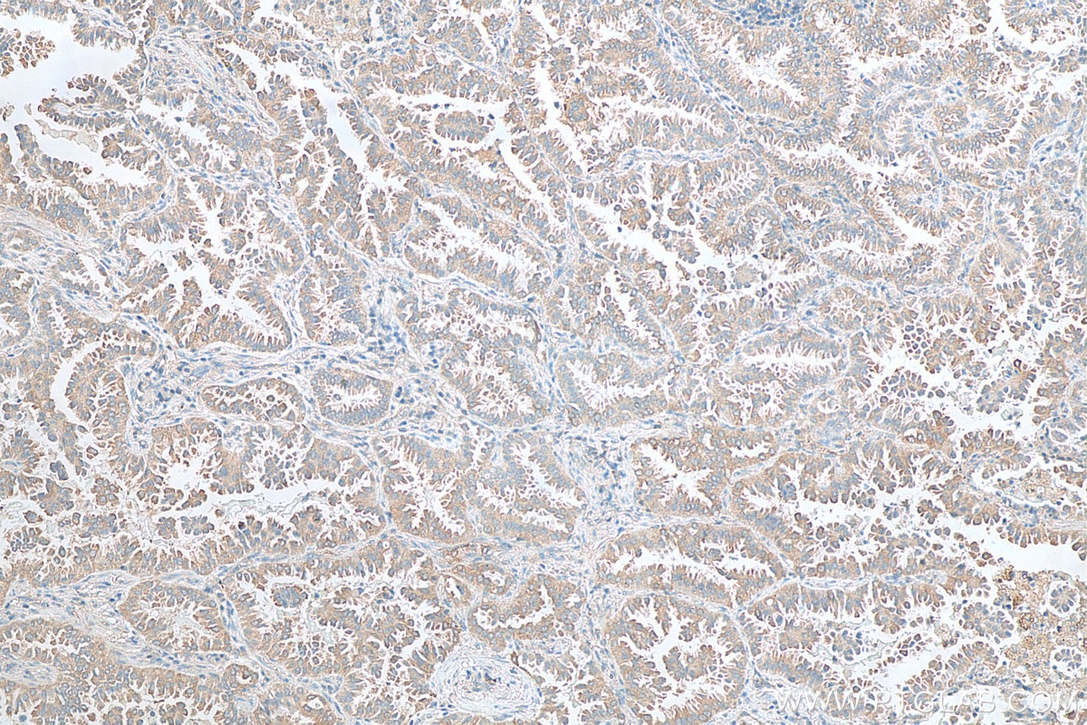 IHC staining of human lung cancer using 13389-1-AP