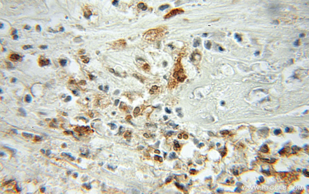 Immunohistochemistry (IHC) staining of human colon cancer tissue using Profilin 1 Polyclonal antibody (11680-1-AP)