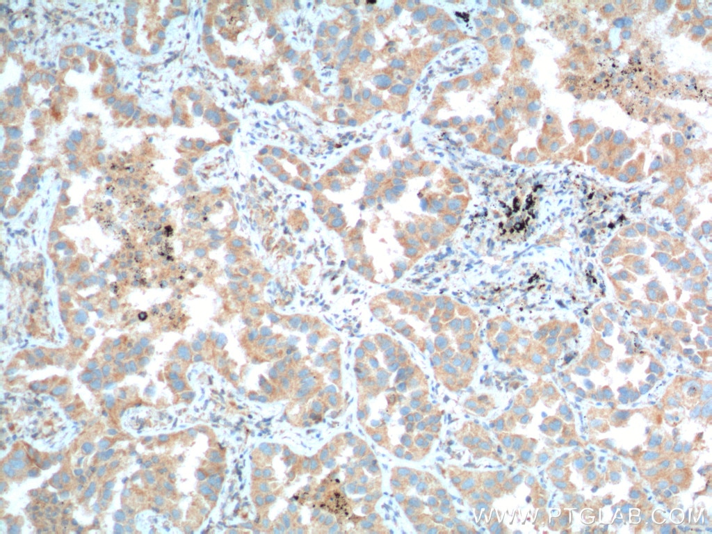 Immunohistochemistry (IHC) staining of human lung cancer tissue using PFN2 Monoclonal antibody (60094-2-Ig)